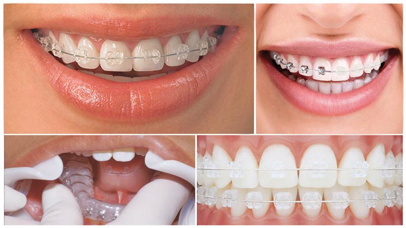 Aparelhos ortodônticos modernos